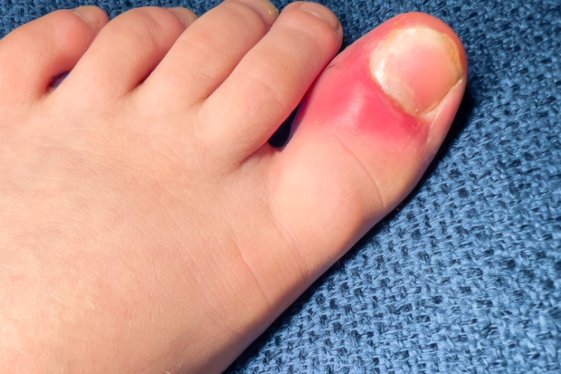 Ingrown Toenails Causes, Treatment, and Prevention